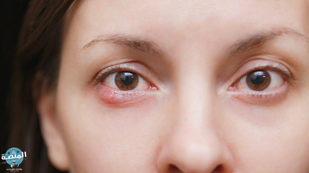 علاج دمل العين وأسباب الاصابة به