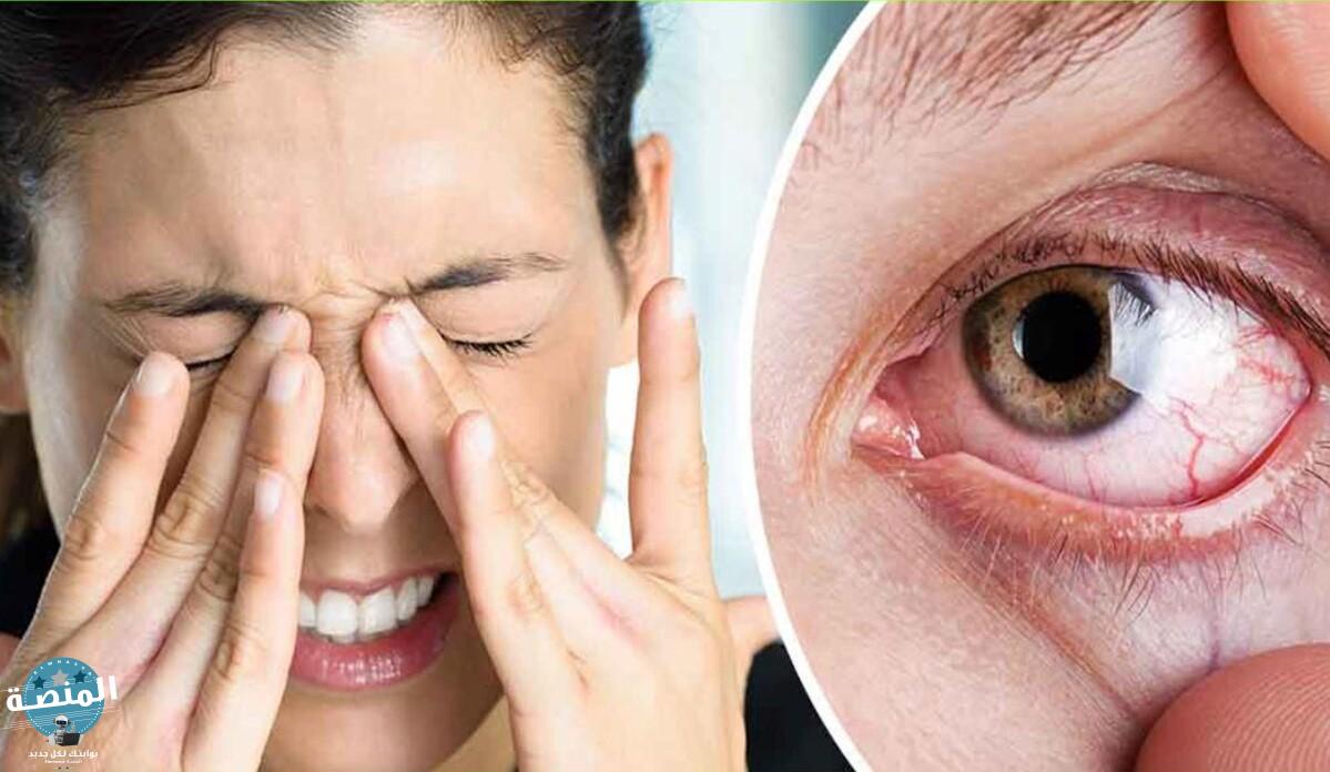 أعراض جفاف العين