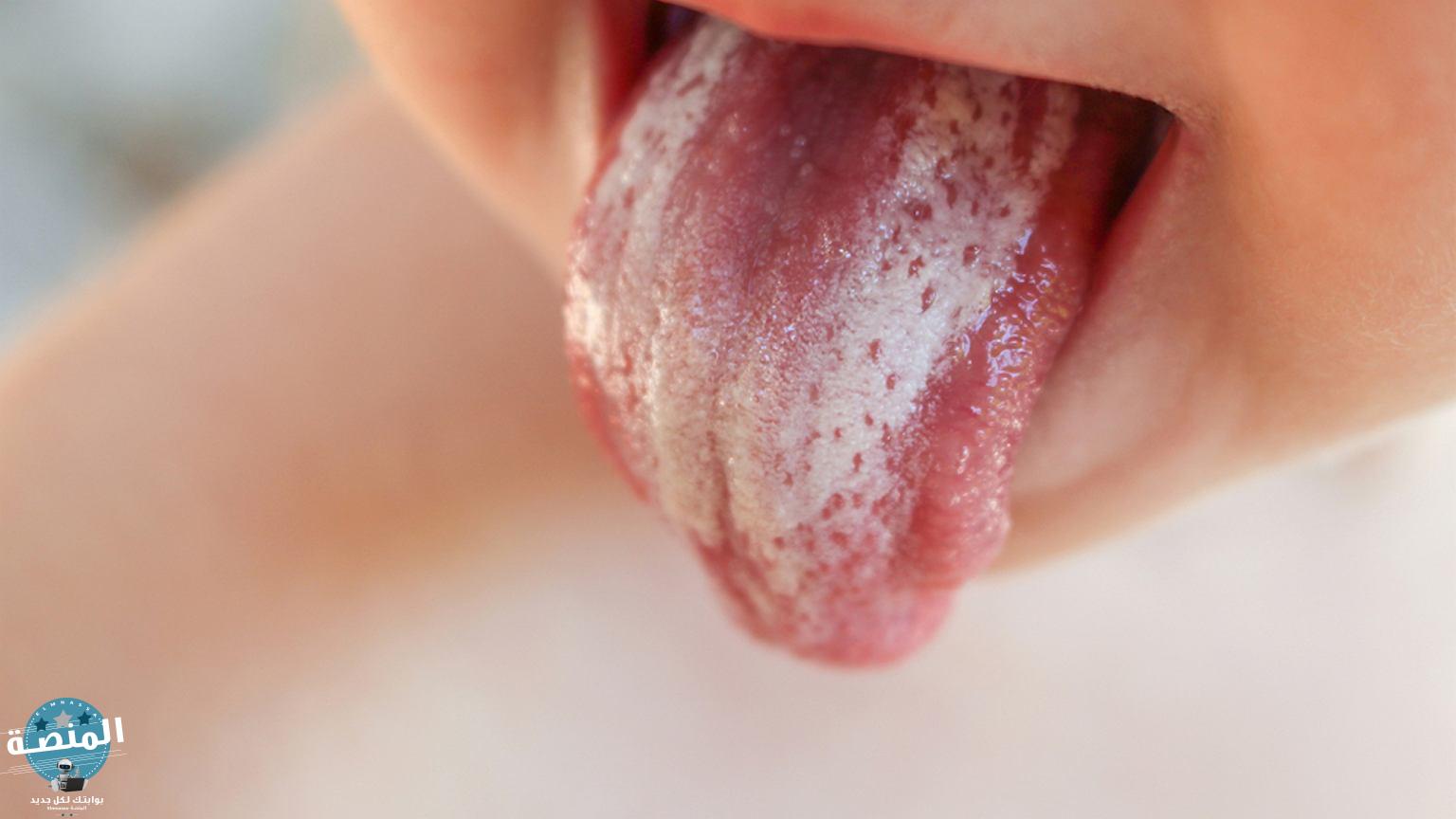 أسباب فطريات الفم وعوامل خطر الإصابة بمرض القلاع