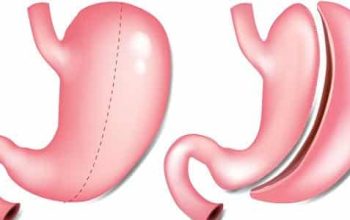 أهم المعلومات عن تكميم المعدة مع الحمل