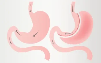 هل عملية تكميم المعدة تناسبني؟