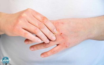 أهم نصائح علاج مرهم لعلاج جروح السكر