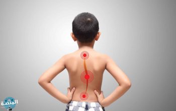 أسباب الجنف